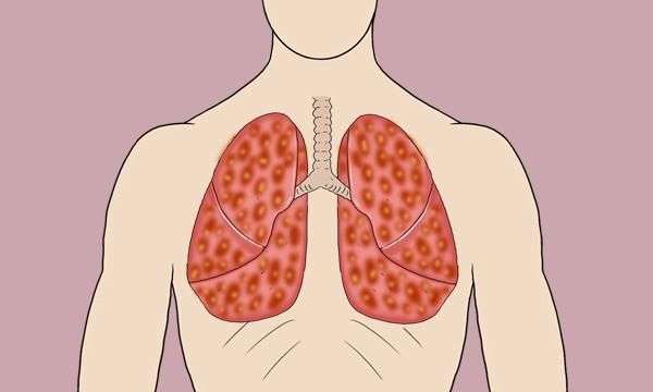 抽烟是导致肺癌的主要原因,肺癌大多数都是抽烟造成的吗图1