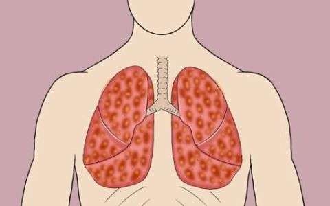 抽烟是导致肺癌的主要原因,肺癌大多数都是抽烟造成的吗